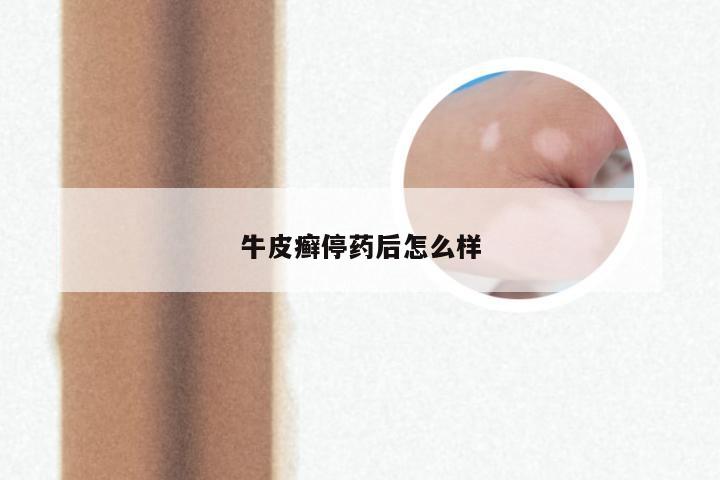牛皮癣停药后怎么样