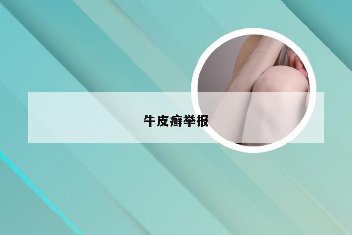 牛皮癣举报
