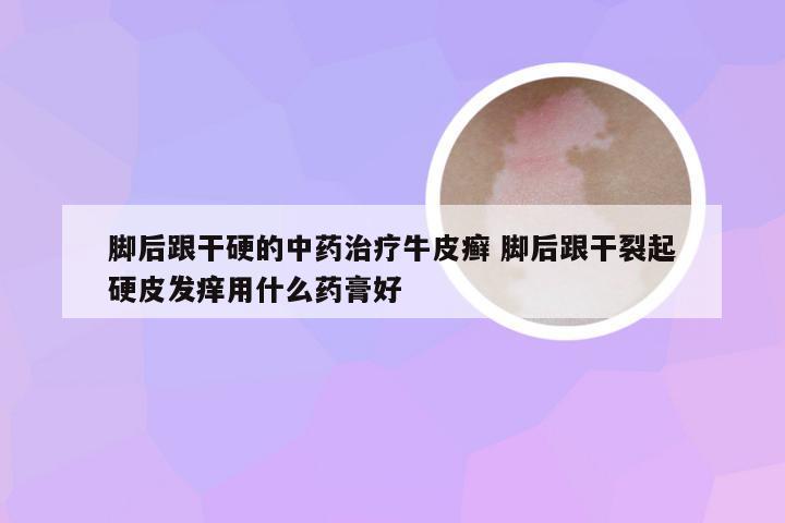 脚后跟干硬的中药治疗牛皮癣 脚后跟干裂起硬皮发痒用什么药膏好