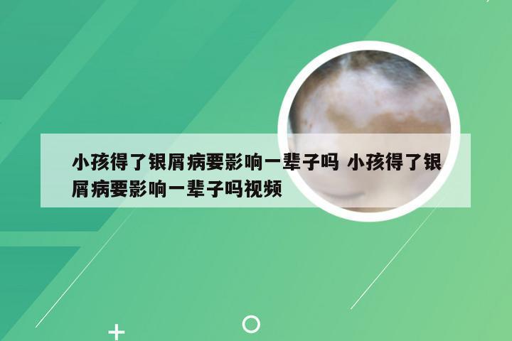 小孩得了银屑病要影响一辈子吗 小孩得了银屑病要影响一辈子吗视频