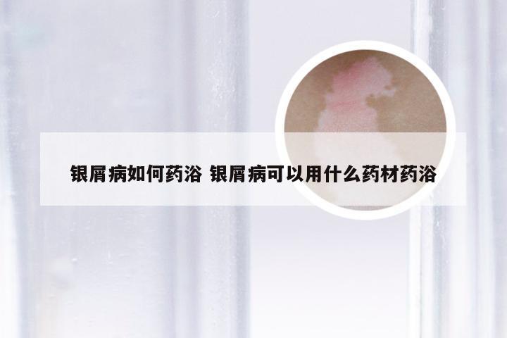 银屑病如何药浴 银屑病可以用什么药材药浴