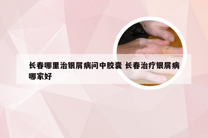 长春哪里治银屑病问中胶囊 长春治疗银屑病哪家好