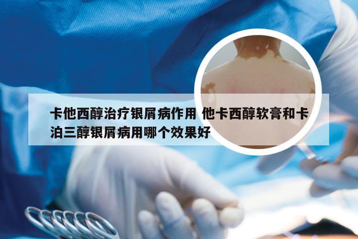 卡他西醇治疗银屑病作用 他卡西醇软膏和卡泊三醇银屑病用哪个效果好