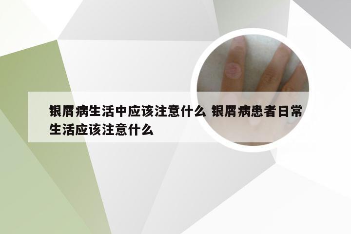 银屑病生活中应该注意什么 银屑病患者日常生活应该注意什么