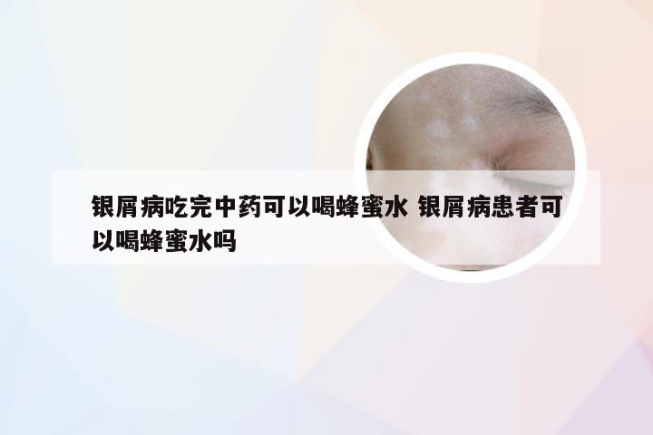 银屑病吃完中药可以喝蜂蜜水 银屑病患者可以喝蜂蜜水吗