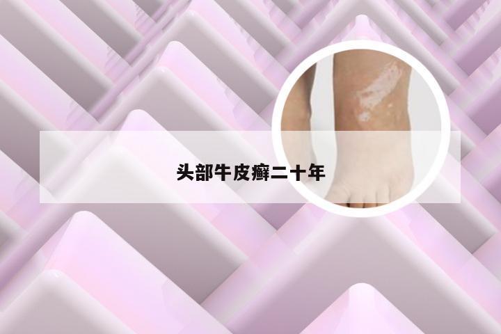 头部牛皮癣二十年