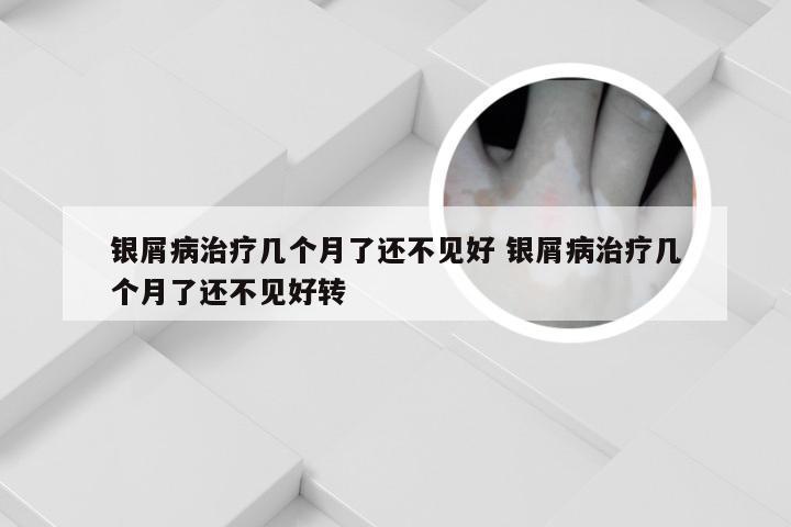 银屑病治疗几个月了还不见好 银屑病治疗几个月了还不见好转