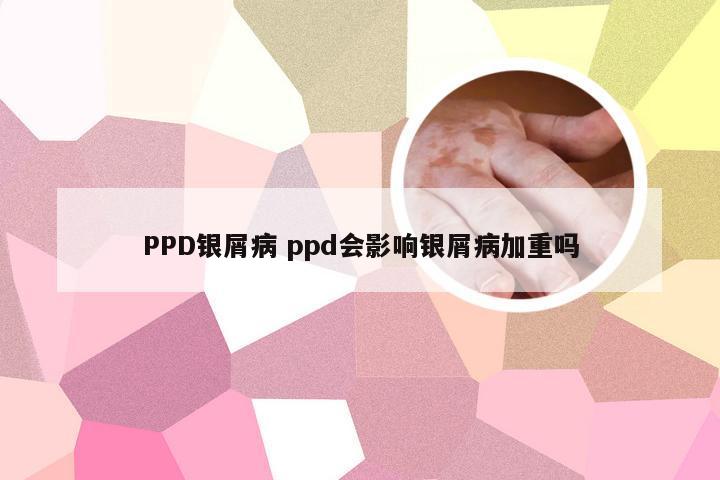 PPD银屑病 ppd会影响银屑病加重吗