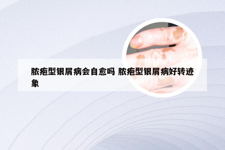 脓疱型银屑病会自愈吗 脓疱型银屑病好转迹象