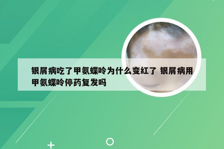 银屑病吃了甲氨蝶呤为什么变红了 银屑病用甲氨蝶呤停药复发吗