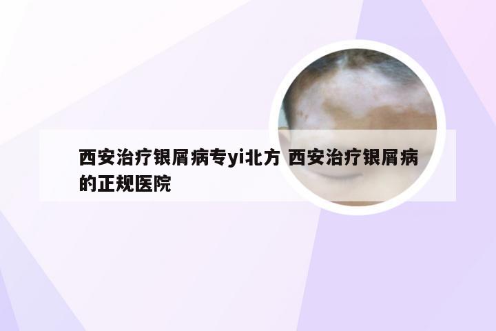 西安治疗银屑病专yi北方 西安治疗银屑病的正规医院