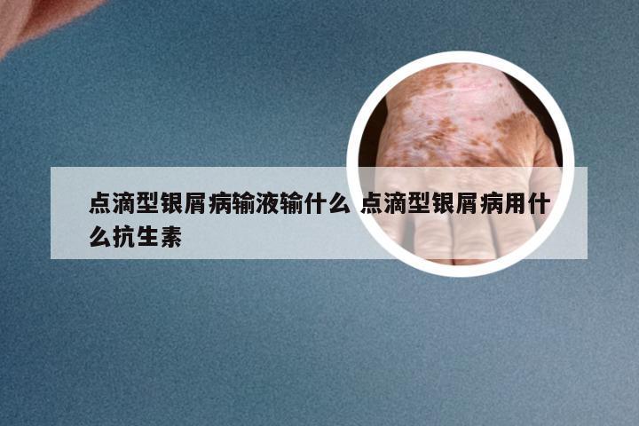 点滴型银屑病输液输什么 点滴型银屑病用什么抗生素