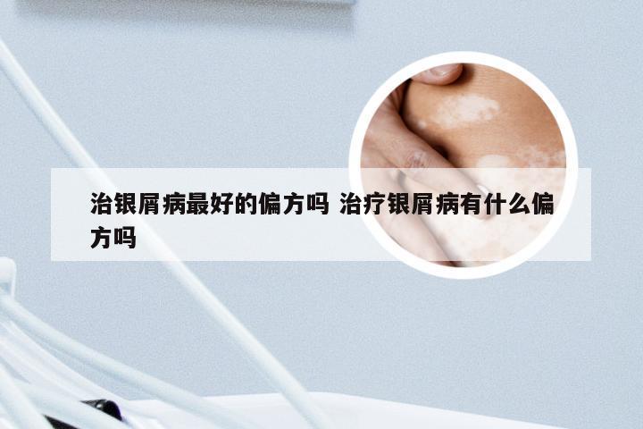 治银屑病最好的偏方吗 治疗银屑病有什么偏方吗