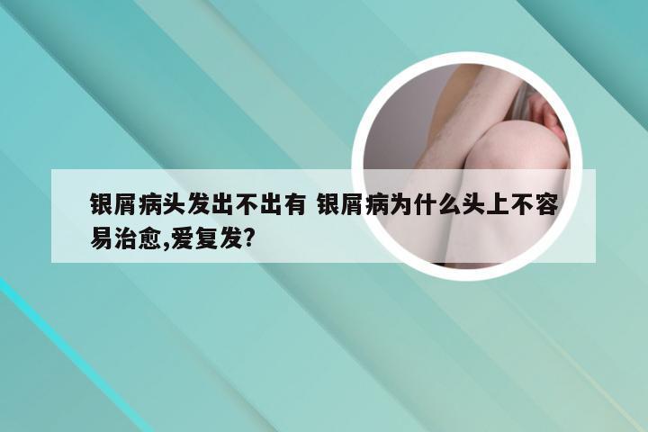 银屑病头发出不出有 银屑病为什么头上不容易治愈,爱复发?