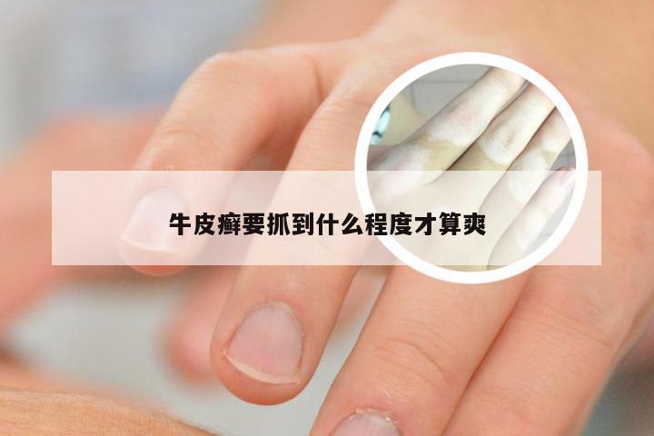 牛皮癣要抓到什么程度才算爽