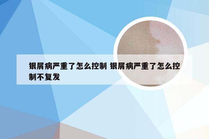 银屑病严重了怎么控制 银屑病严重了怎么控制不复发