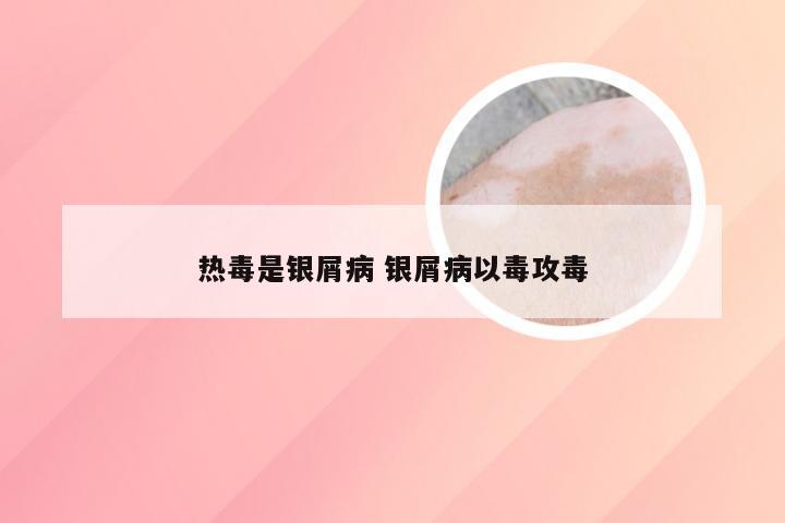 热毒是银屑病 银屑病以毒攻毒