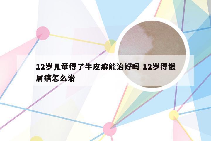 12岁儿童得了牛皮癣能治好吗 12岁得银屑病怎么治