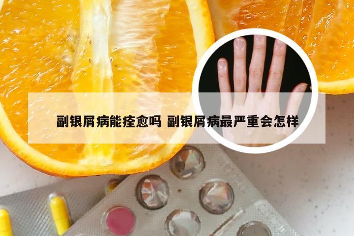 副银屑病能痊愈吗 副银屑病最严重会怎样