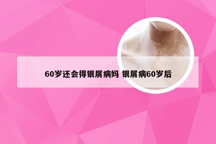 60岁还会得银屑病妈 银屑病60岁后