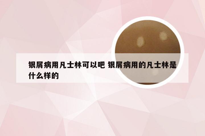 银屑病用凡士林可以吧 银屑病用的凡士林是什么样的