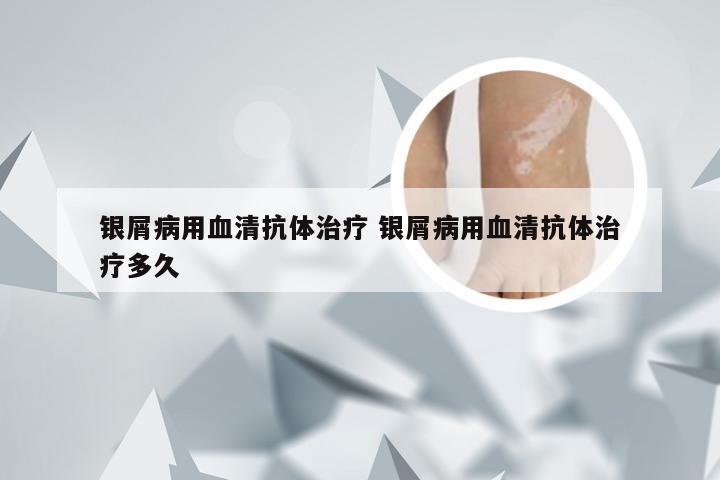 银屑病用血清抗体治疗 银屑病用血清抗体治疗多久