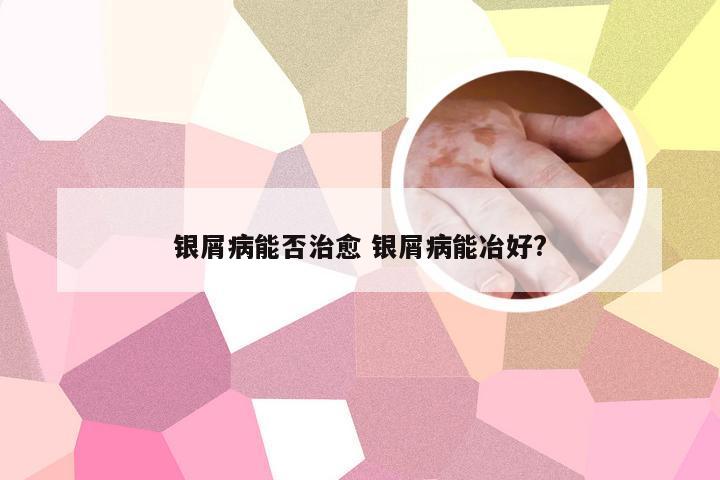 银屑病能否治愈 银屑病能冶好?