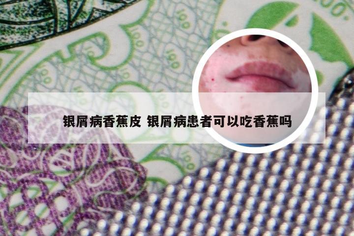 银屑病香蕉皮 银屑病患者可以吃香蕉吗