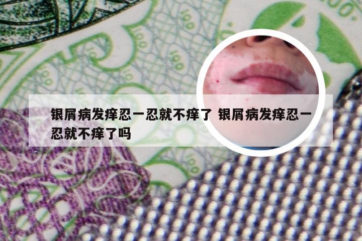 银屑病发痒忍一忍就不痒了 银屑病发痒忍一忍就不痒了吗