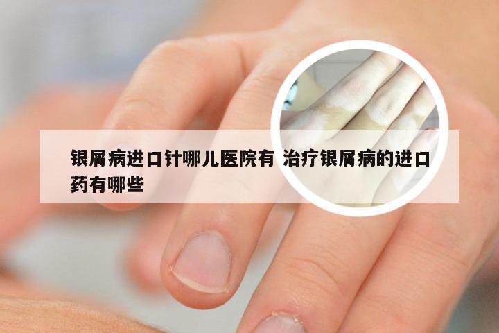 银屑病进口针哪儿医院有 治疗银屑病的进口药有哪些