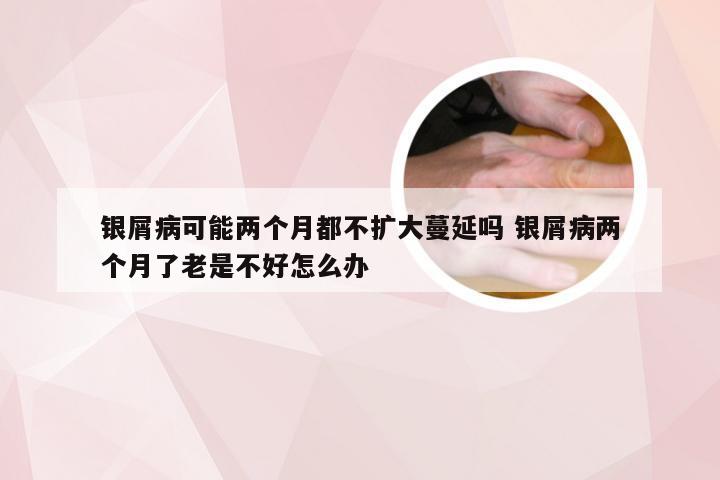 银屑病可能两个月都不扩大蔓延吗 银屑病两个月了老是不好怎么办