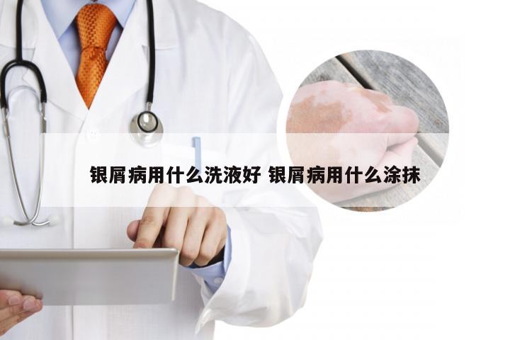 银屑病用什么洗液好 银屑病用什么涂抹