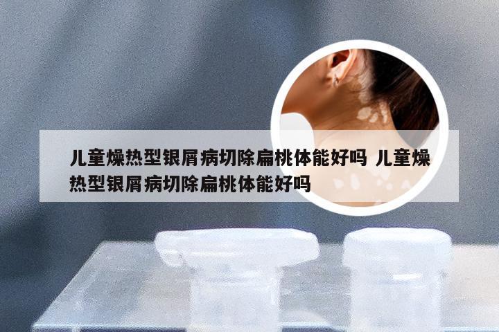 儿童燥热型银屑病切除扁桃体能好吗 儿童燥热型银屑病切除扁桃体能好吗