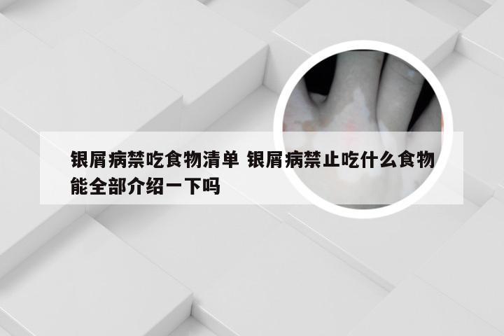 银屑病禁吃食物清单 银屑病禁止吃什么食物能全部介绍一下吗