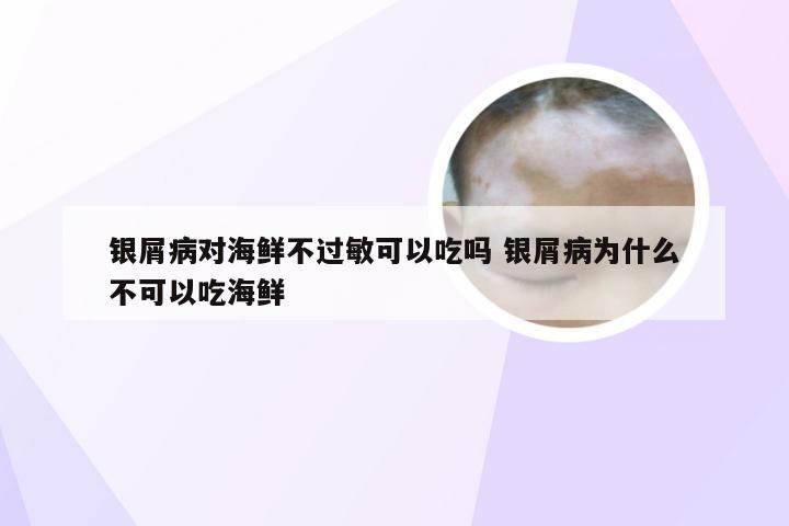 银屑病对海鲜不过敏可以吃吗 银屑病为什么不可以吃海鲜