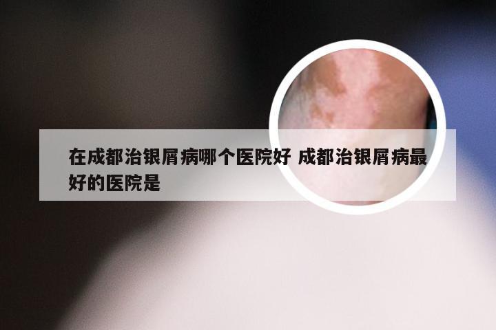 在成都治银屑病哪个医院好 成都治银屑病最好的医院是