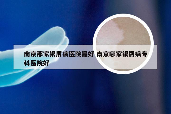 南京那家银屑病医院最好 南京哪家银屑病专科医院好