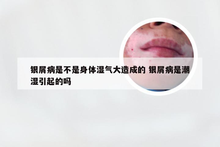 银屑病是不是身体湿气大造成的 银屑病是潮湿引起的吗