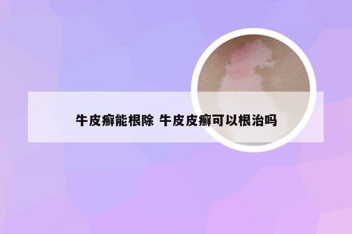 牛皮癣能根除 牛皮皮癣可以根治吗