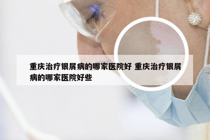 重庆治疗银屑病的哪家医院好 重庆治疗银屑病的哪家医院好些