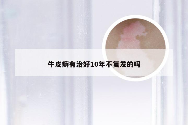 牛皮癣有治好10年不复发的吗