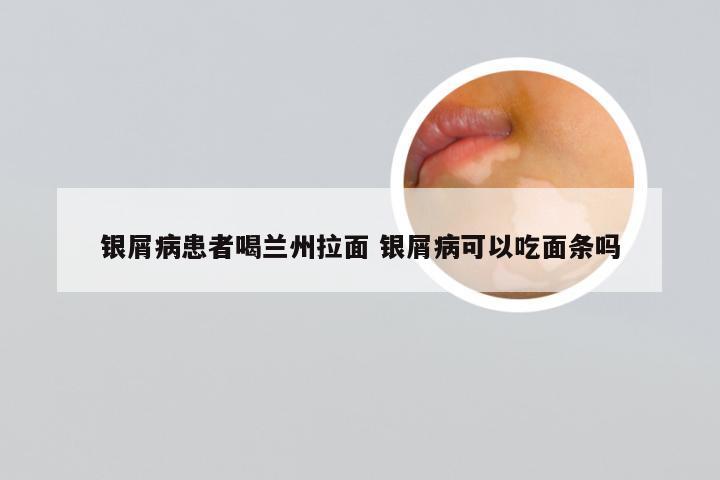 银屑病患者喝兰州拉面 银屑病可以吃面条吗