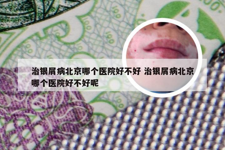 治银屑病北京哪个医院好不好 治银屑病北京哪个医院好不好呢