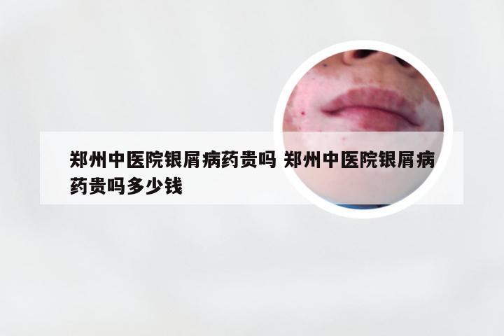 郑州中医院银屑病药贵吗 郑州中医院银屑病药贵吗多少钱