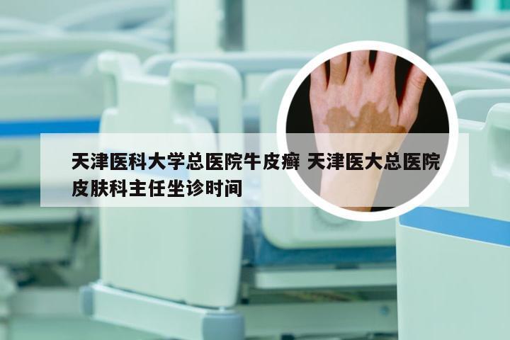 天津医科大学总医院牛皮癣 天津医大总医院皮肤科主任坐诊时间