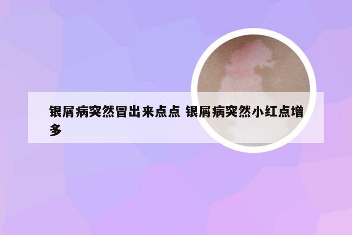 银屑病突然冒出来点点 银屑病突然小红点增多