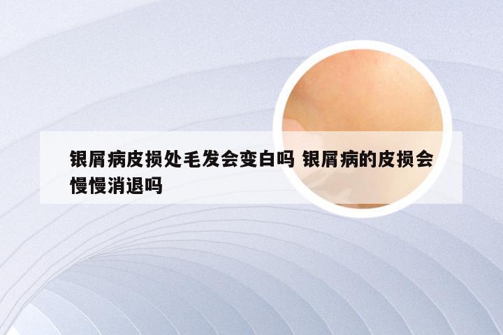 银屑病皮损处毛发会变白吗 银屑病的皮损会慢慢消退吗