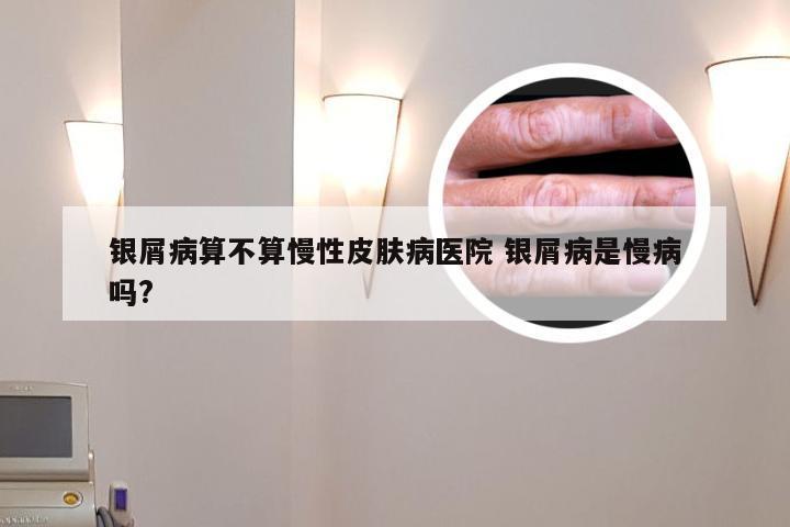 银屑病算不算慢性皮肤病医院 银屑病是慢病吗?