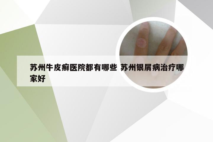 苏州牛皮癣医院都有哪些 苏州银屑病治疗哪家好