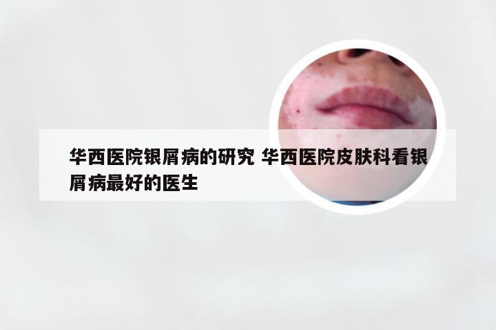 华西医院银屑病的研究 华西医院皮肤科看银屑病最好的医生